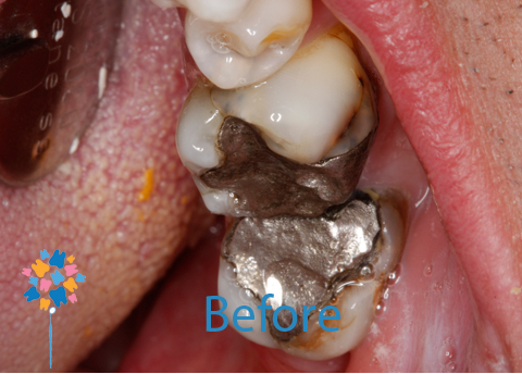 Tooth Coloured Fillings Before