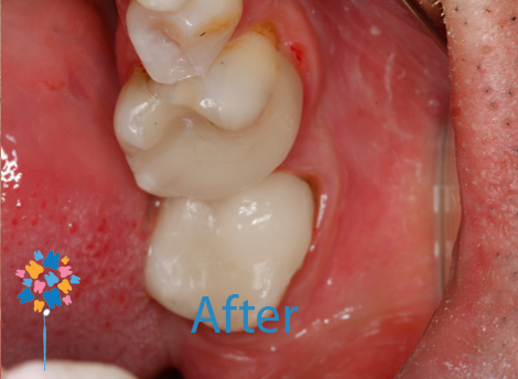 Tooth Coloured Fillings After